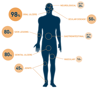 Diagram to understand symptoms of behcet's disease